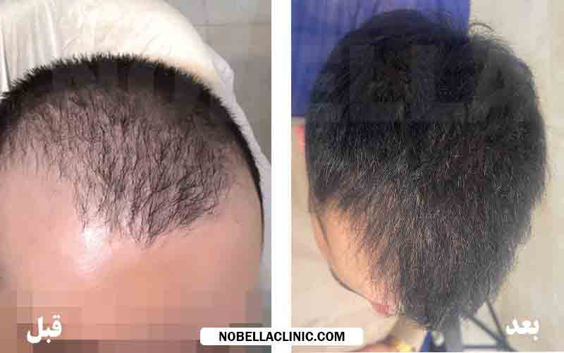 عکس قبل و بعد از پی آر پی مو آقایان در نوبلا