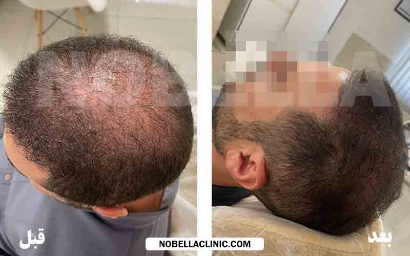 عکس قبل و بعد از پی آر پی مو آقایان در نوبلا