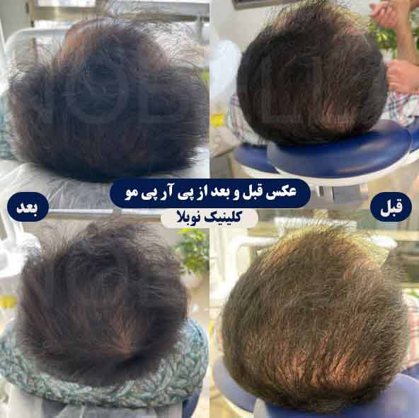 عکس قبل و بعد از پی آر پی مو