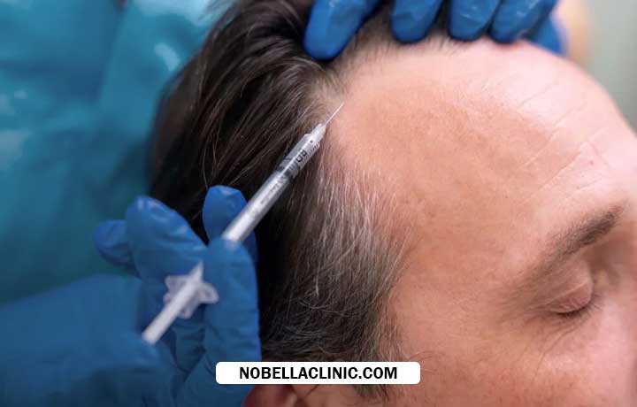 اگزوزوم تراپی مو در کلینیک نوبلا