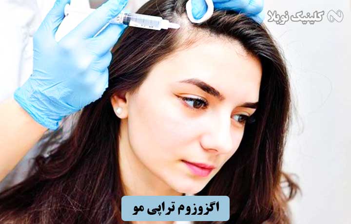 اگزوزوم تراپی مو برای درمان ریزش مو با سلول بنیادی ؛ هزینه و عوارض
