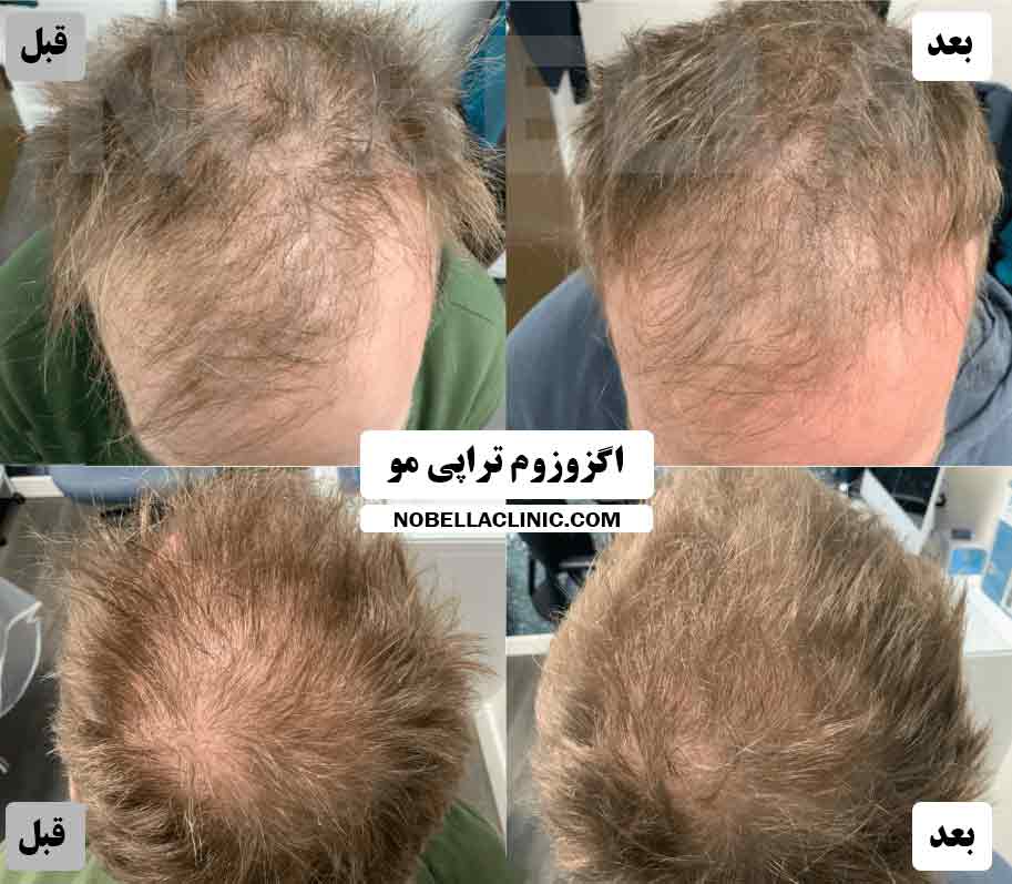 اگزوزوم تراپی مو سلول بنیادی