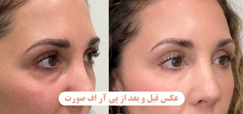 عکس قبل و بعد از پی آر اف صورت