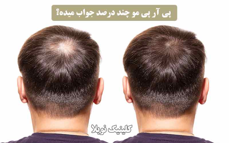 ✔️ پی آر پی مو چند درصد جواب میده ؟ درمان ریزش مو با PRP