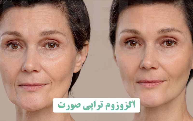 اگزوزوم صورت | کاربرد، عوارض و هزینه
