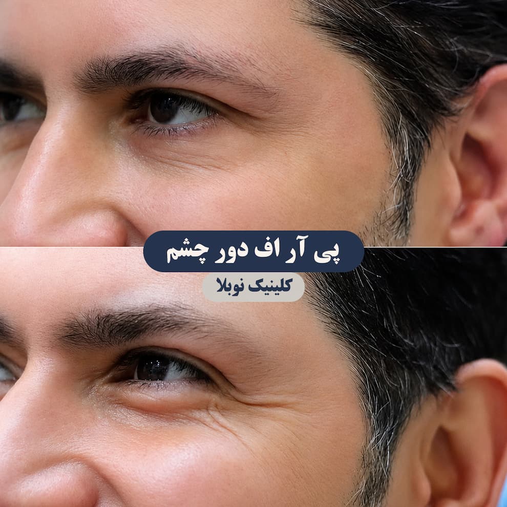 پی ار پی زیر چشم