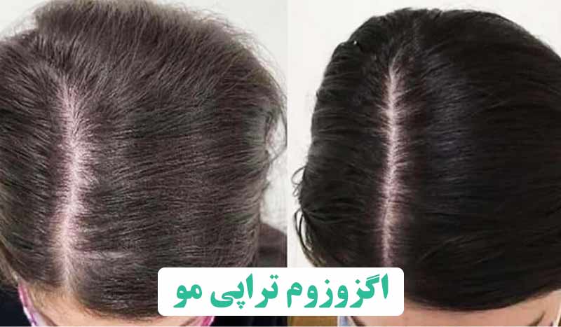 اگزوزوم تراپی در تهران برای کاهش ریزش مو