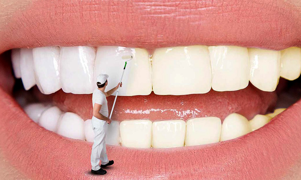 بلیچینگ دندان در یک جلسه؛ امکان‌پذیر است؟