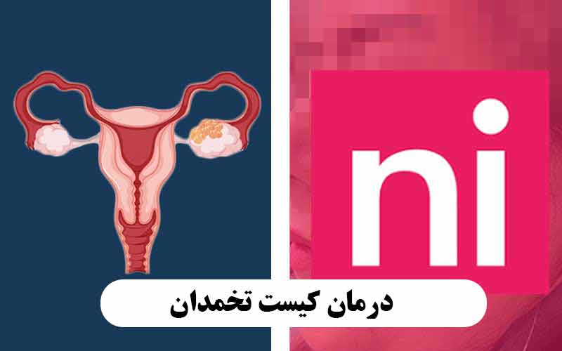 درمان کیست تخمدان نی نی سایت + تصاویر نظرات