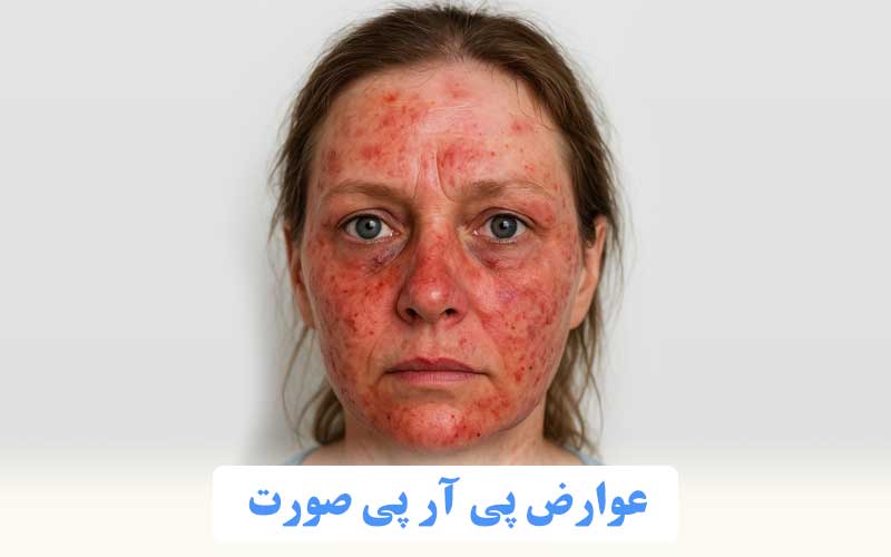 عوارض پی آر پی صورت