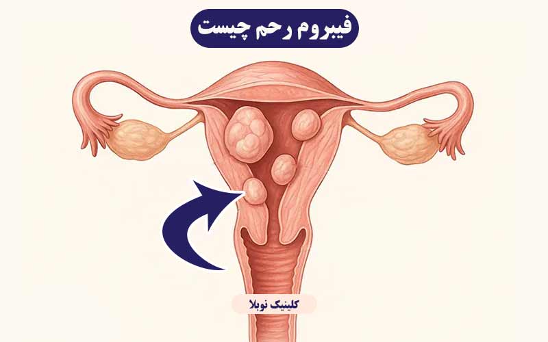 فیبروم رحم چیست ؟ علت ، علائم و درمان فیبروم