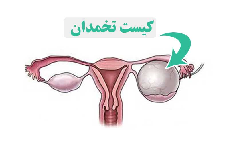 قاتل کیست تخمدان | درمان سریع کیست تخمدان ( خانگی و پزشکی )
