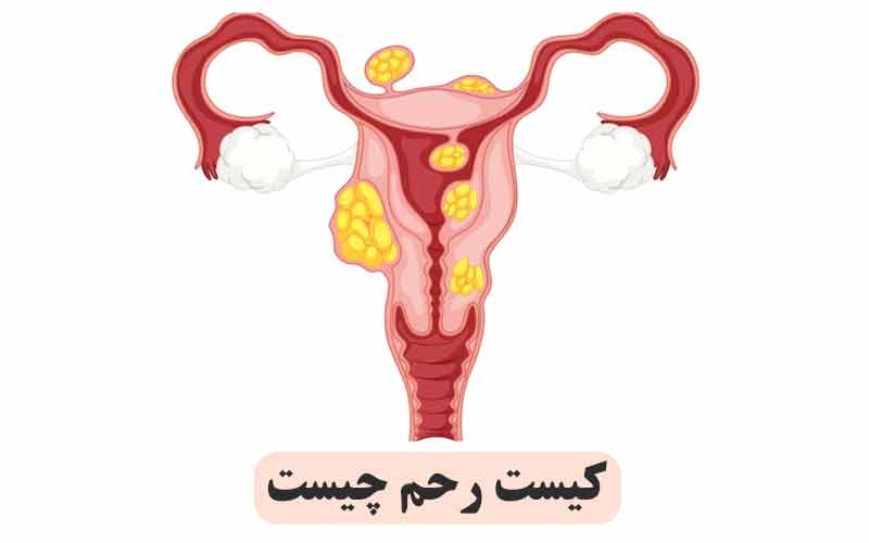 کیست رحم چیست و چه عوارضی دارد