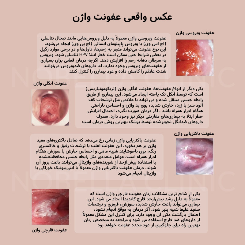 عکس واقعی عفونت قارچی واژن نی نی سایت
