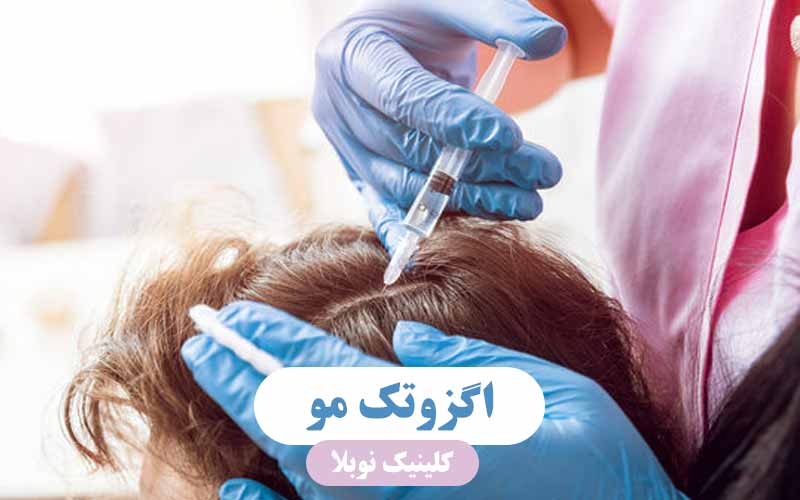 ✔️اگزوتک مو در تهران برای درمان ریزش مو
