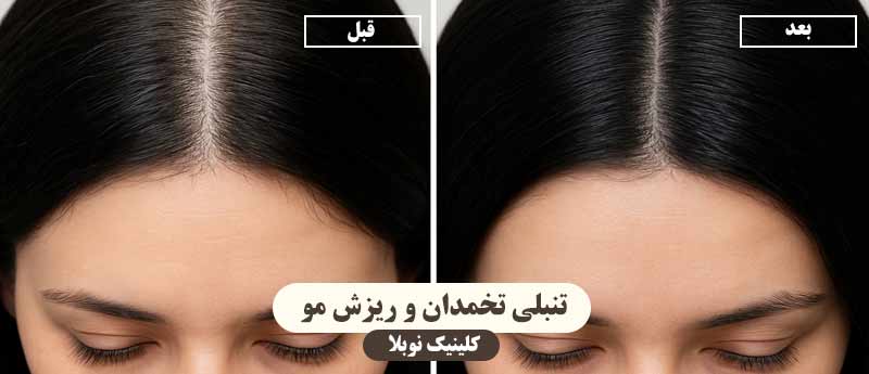 تنبلی تخمدان و ریزش مو نی نی سایت