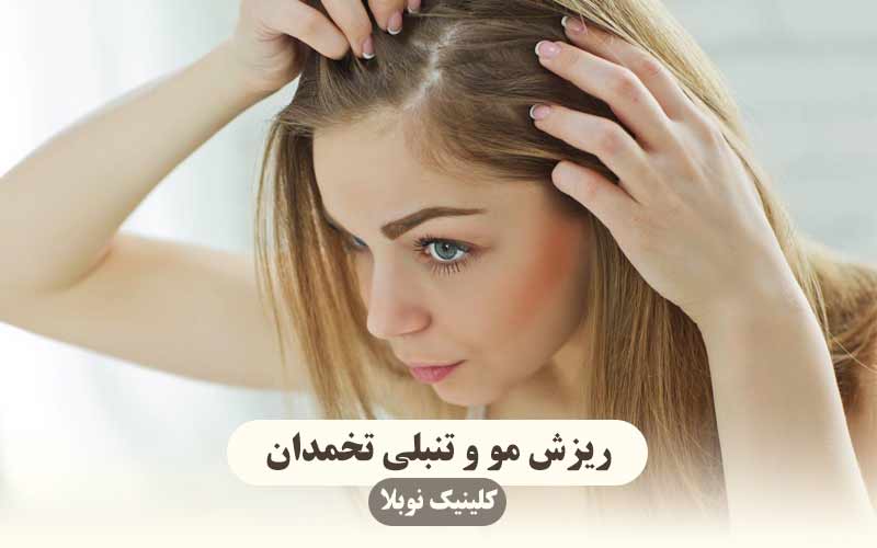 درمان ریزش مو ناشی از تنبلی تخمدان ( نظر پزشک )