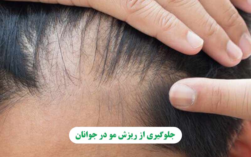 جلوگیری از ریزش مو در جوانان