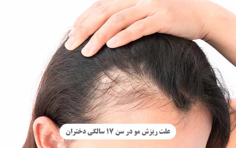 علت ریزش مو در سن 17 سالگی دختران