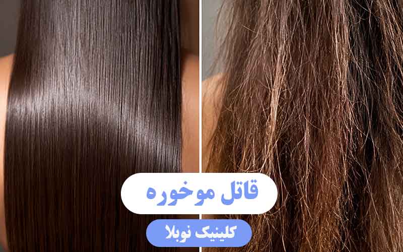 قاتل موخوره را بشناسید ؛ معجزه پلاسما برای احیای مو