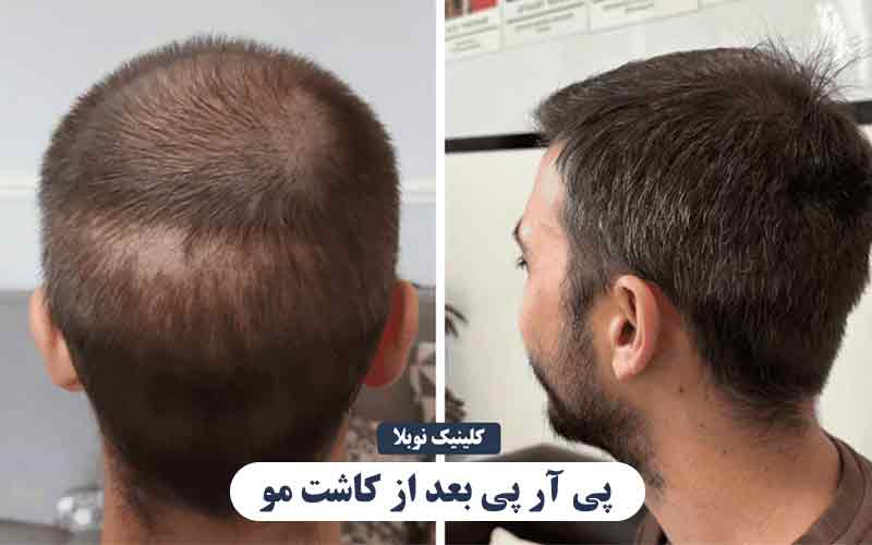 پی آر پی بعد از کاشت مو