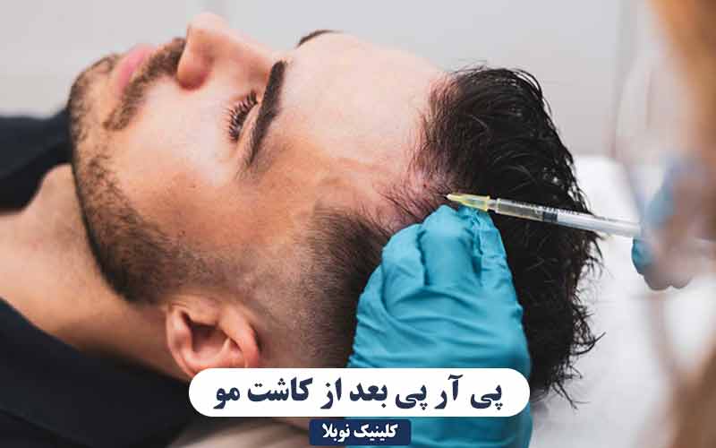 پی ار پی بعد از کاشت مو