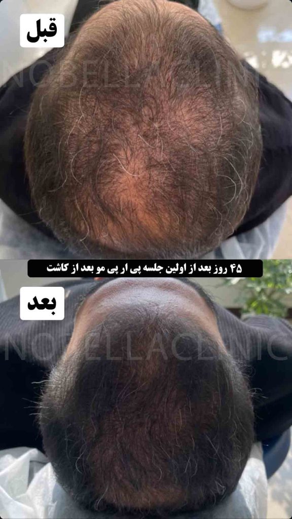 پی ار پی مو بعد از کاشت مو در کلینیک نوبلا