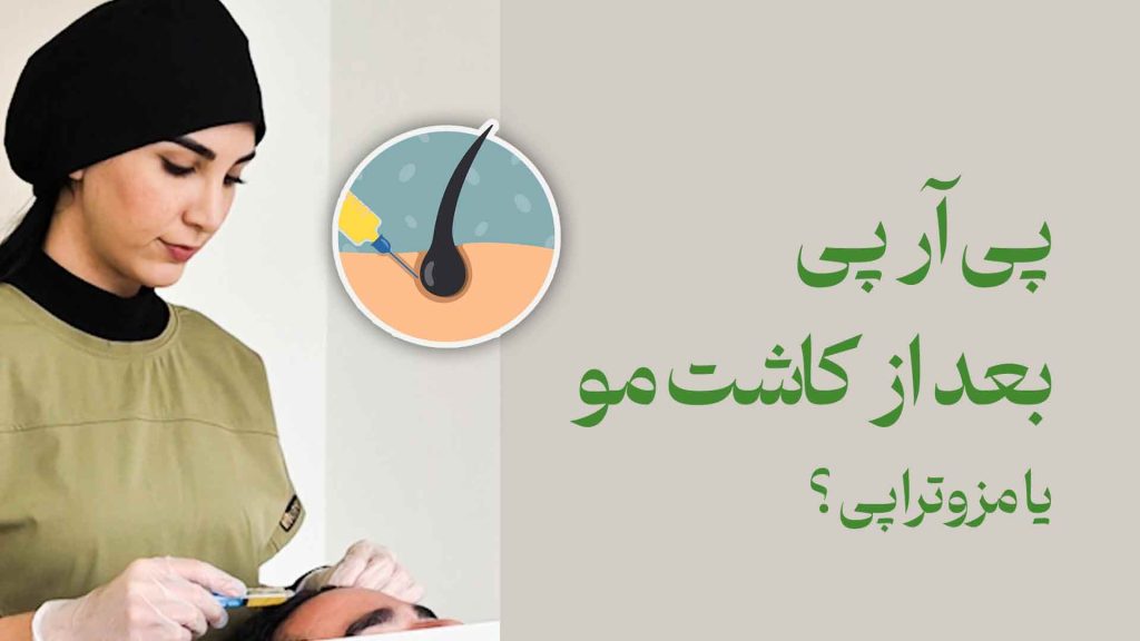 پی آر پی بعد از کاشت مو